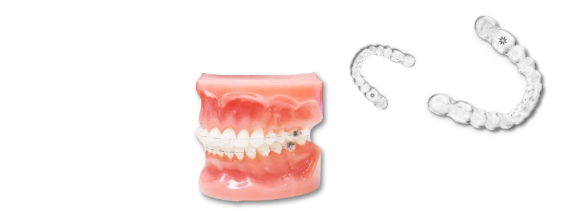 Retainer Replacement Greenville Retainer Replacement